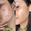 Anti-Acne Combo