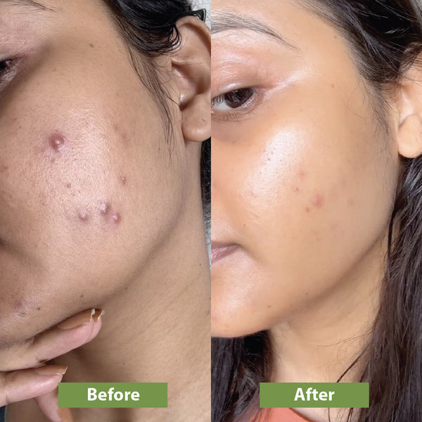 Anti-Acne Combo